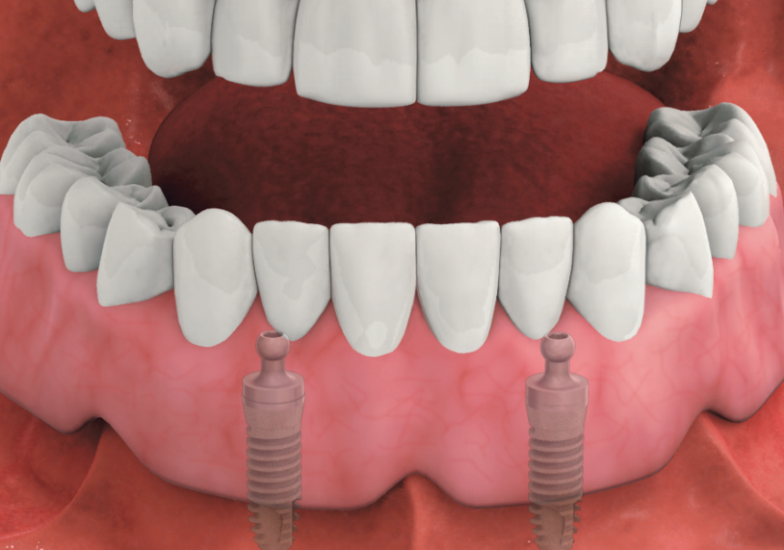 Prothese auf Implantaten